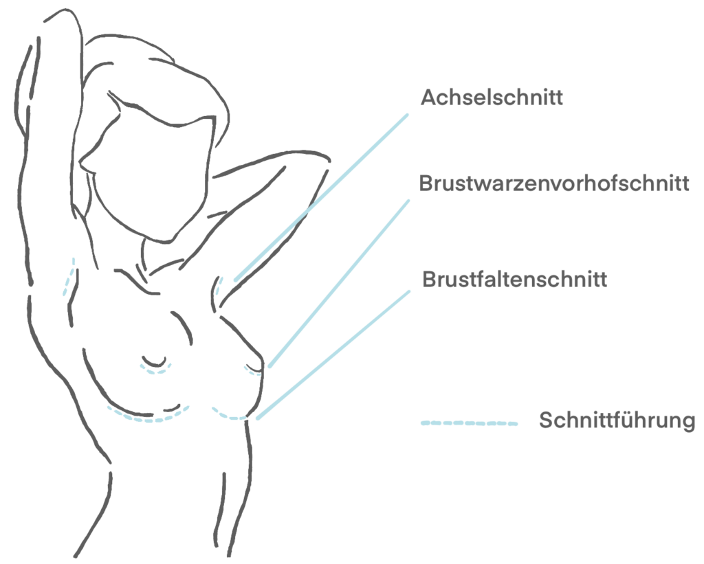 Breast augmentation methods