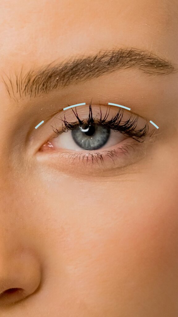 Upper eyelid lift