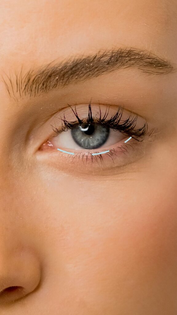 Lower eyelid lift, incision